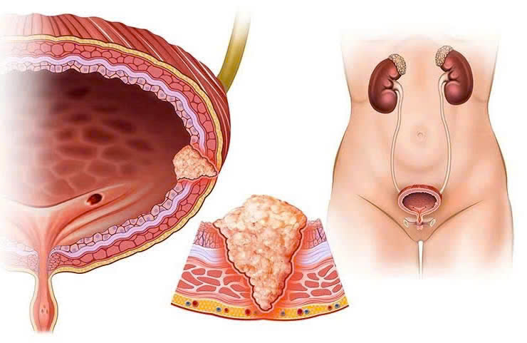 Sự hồi phục kỳ diệu của nam bệnh nhân sau 12 năm cắt toàn bộ bàng quang và tái tạo bằng ruột- Ảnh 3.